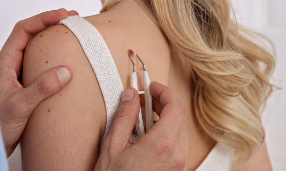 Mole Removal