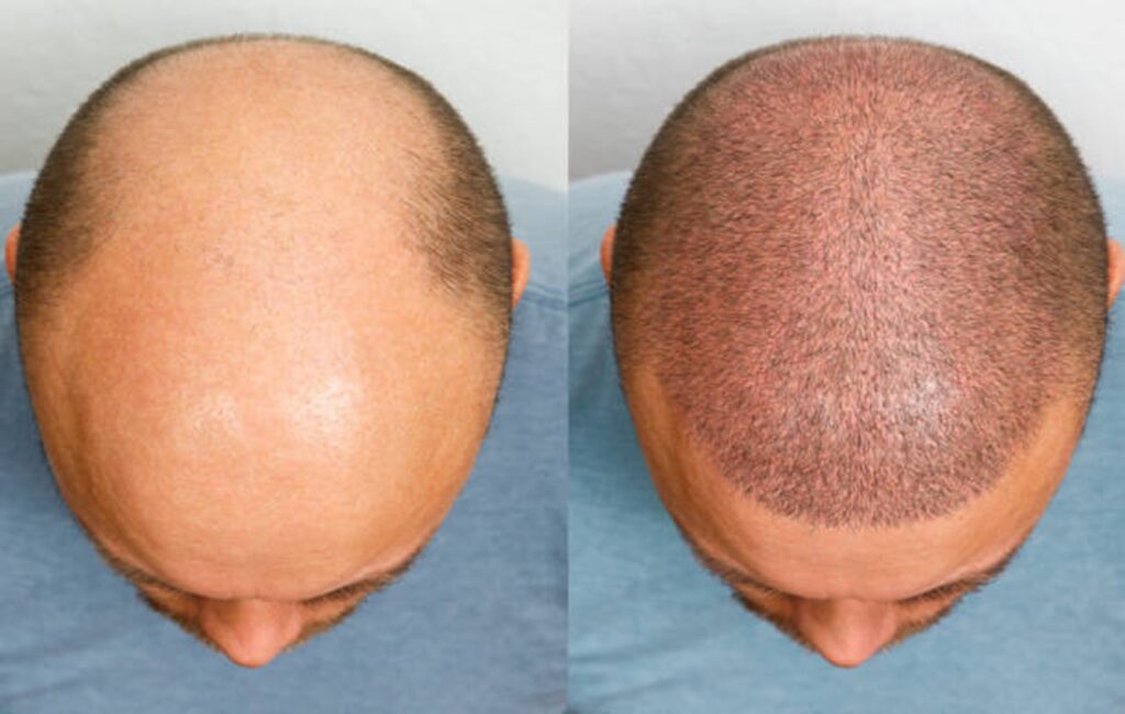 hair loss clinic UK